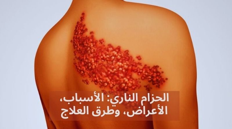 حزامً ناري: الأسباب، الأعراض، والعلاج