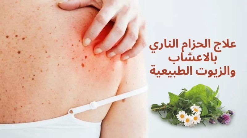 علاج الحزام الناري بالاعشاب والزيوت الطبيعية