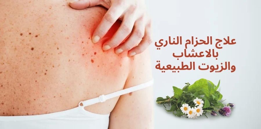 علاج الحزام الناري بالاعشاب والزيوت الطبيعية