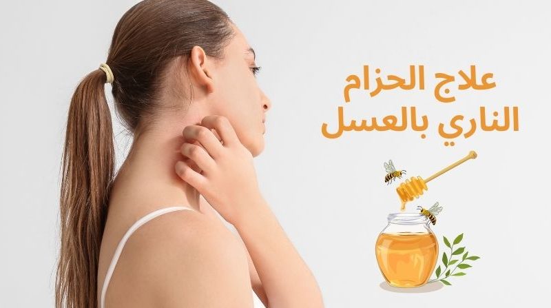 علاج الحزام الناري بالعسل