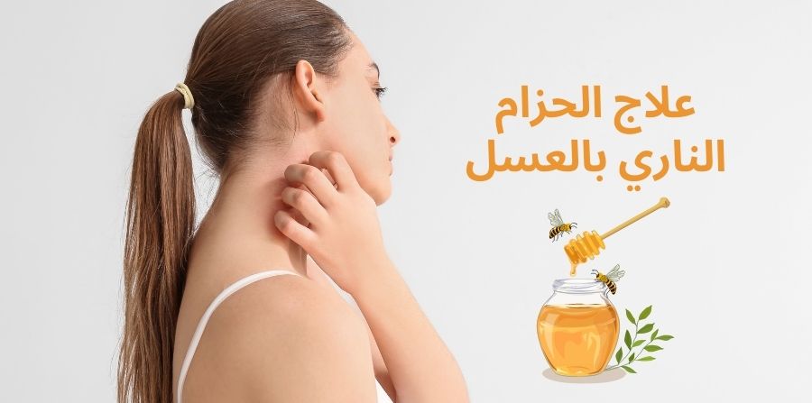 علاج الحزام الناري بالعسل