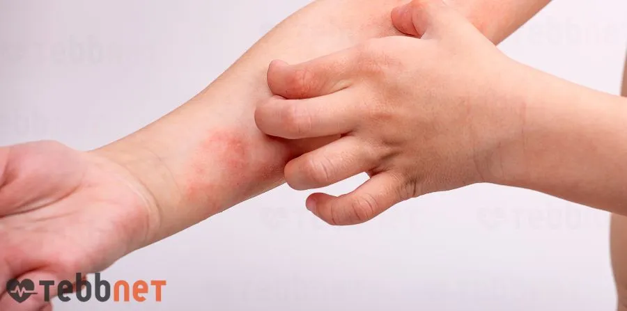 النوع الأول من أنواع الإكزيما عند الأطفال بالصور  وهو التهاب الجلد العصبي (Neurodermatitis)