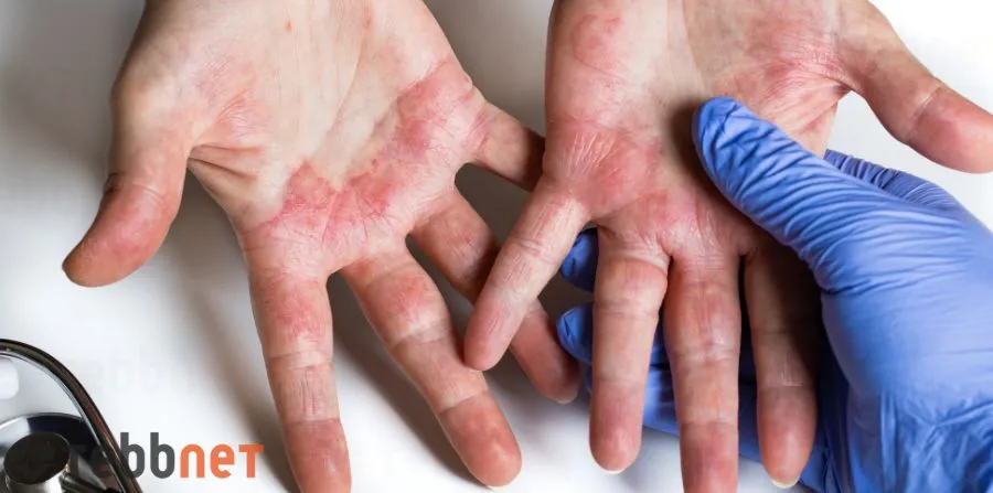 النوع الأول من أنواع الإكزيما عند الأطفال بالصور  وهو الإكزيما التعرقية (Dyshidrotic eczema)