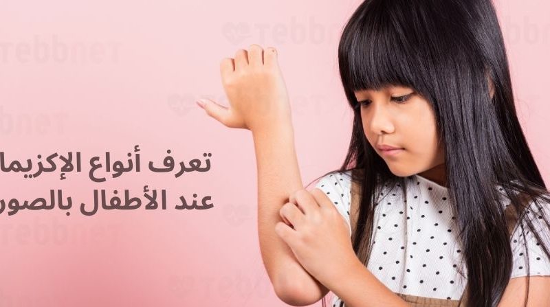 أنواع الإكزيما عند الأطفال بالصور