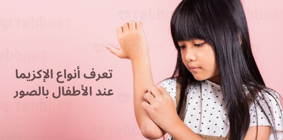 أنواع الإكزيما عند الأطفال بالصور