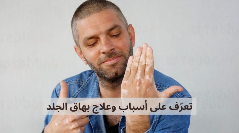 تعرّف على أسباب وعلاج بهاق الجلد: دليل شامل