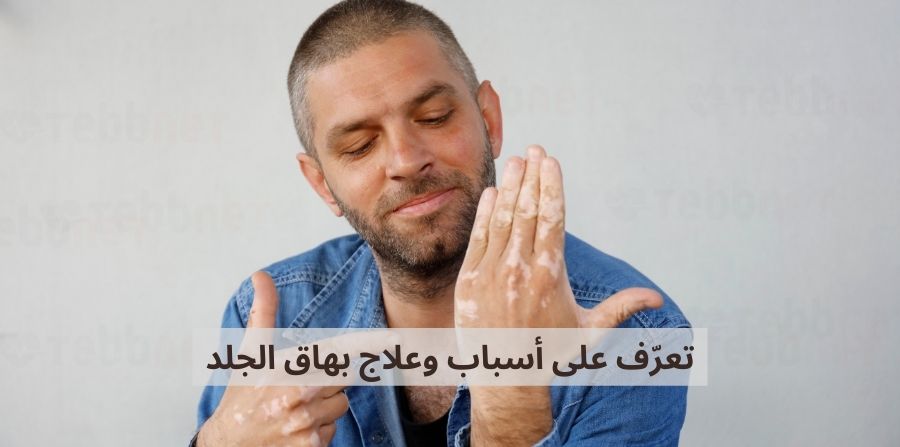 تعرّف على أسباب وعلاج بهاق الجلد: دليل شامل